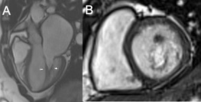 When evaluating a patient with presumed rheumatic mitral stenosis for potential mitral balloon valvuloplasty, possible parachute mitral valve, though rare, needs to be excluded <a href="/rowpower/">David Power</a> #AHAJournals <a href="/JiwonKimMD/">Jiwon Kim, MD</a> <a href="/kaznegishi/">Kaz Negishi@Cardiologist/ Heart Mafia</a>
ahajrnls.org/3G166uk