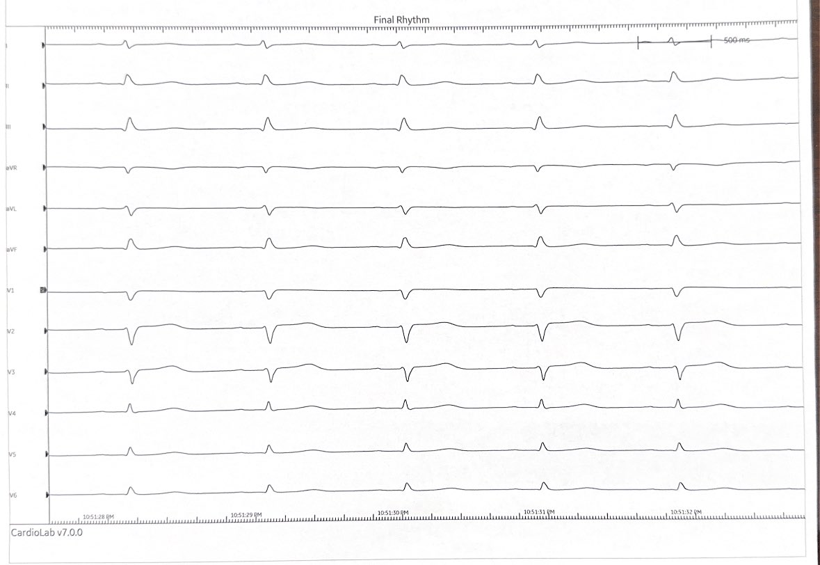 Refractory VF ablation on ECMO. 42 year old ow healthy w 500 shocks (literally) despite amio, lido, esmolol, intubation and pacing. Arrives in lab in VF. Trigger mapped to posterior fasicle, maintaining rhythm for 24 hrs. EP is beautiful because of what we can do for patients.