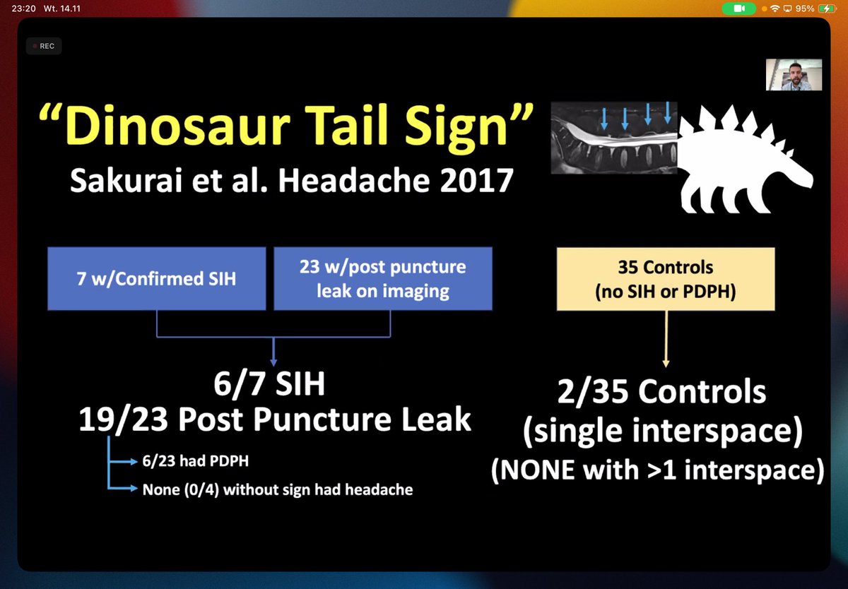 Great talk from @AndrewCallenMD about #csfleak #csf - learned a lot of new things and concepts. Like “dinosaur tail sign”