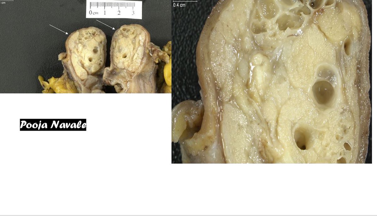 navale_pooja's tweet photo. A nice gross-histology correlation in this case of Brunner gland hyperplasia/hamartoma

#PathTwitter #Medtwitter #Gipath 

@washupathedu @wusm_pathology https://t.co/5wY3fpTTdb