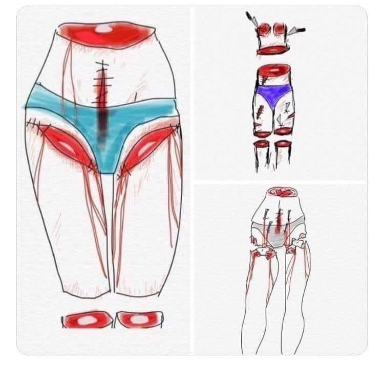 descripción gráfica de los cólicos menstruales