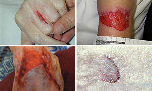 NurseStandard's tweet photo. Skin tears: a guide for nurses

This article identifies the factors that can increase the risk of skin tears and outlines some best practice recommendations on risk assessment, prevention and recognition.

https://t.co/UV5hvB6awC https://t.co/f81lvg7kSl