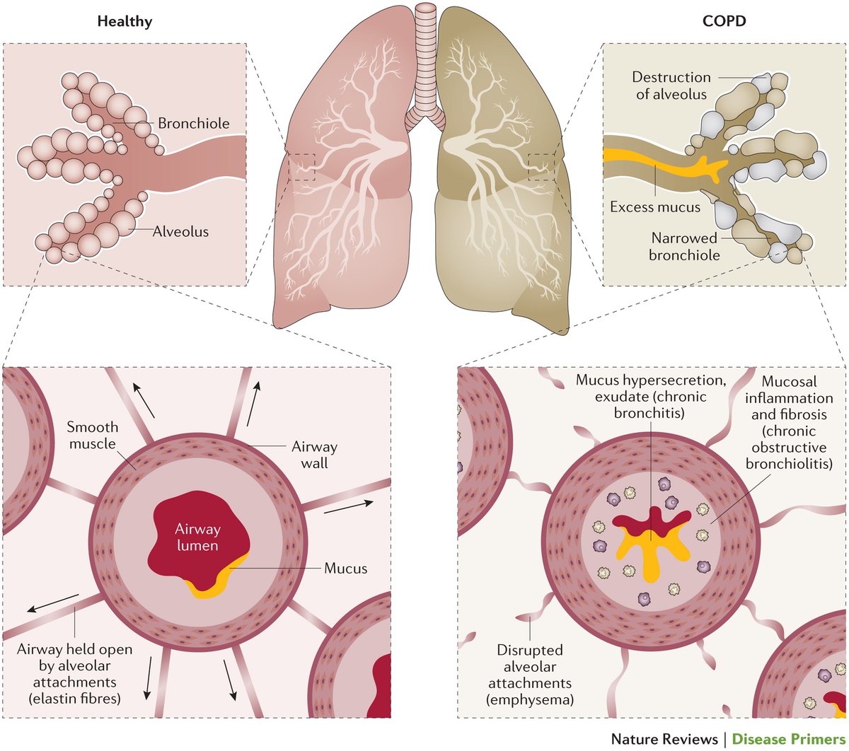 Breathless Contrast: Healthy Lung vs. COPD Witness the stark contrast between a healthy lung and one afflicted by COPD. Chronic cough, a hallmark of COPD, significantly impairs daily life. Addressing this symptom is crucial for better management and improved quality of life.