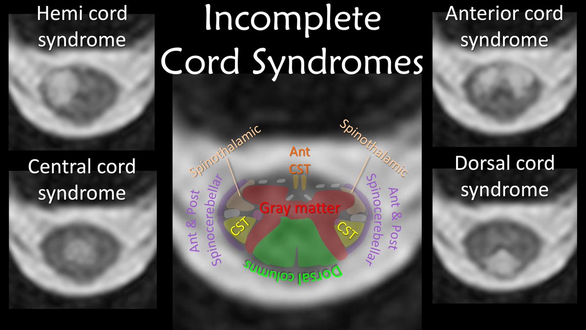 1/”I LOVE spinal cord syndromes!” is a phrase that has NEVER, EVER been said by anyone. Do you become paralyzed when you see cord signal abnormality? Never fear—here is a thread on all the incomplete spinal cord syndromes to get you moving again!