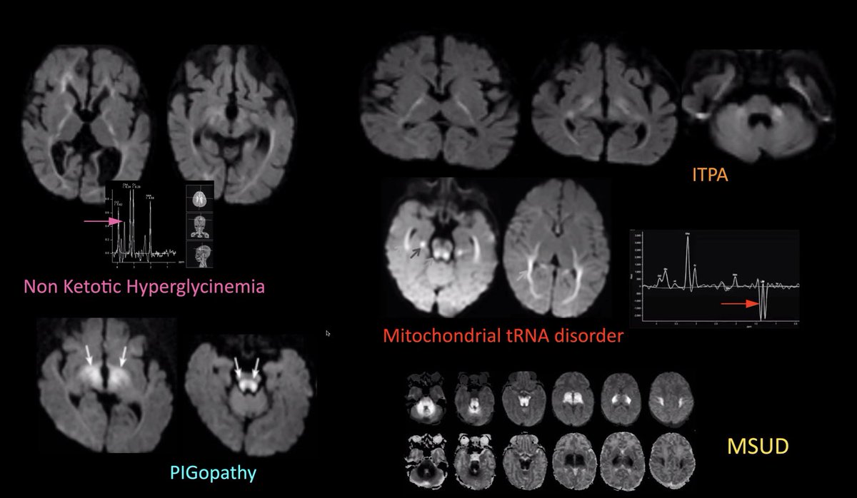 A really strong multidisciplinary meeting, brought to the world every fortnight as a joint <a href="/spinacademics/">SPIN | Society of Pediatric Neuroimaging</a> and <a href="/RCHPedneuro/">RCH PedNeuro</a> offering, under the able chairmanship of <a href="/nihaal08/">Nihaal Reddy</a>. Free education in a format that stimulates.