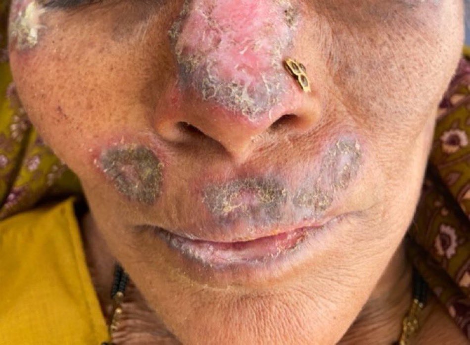 BrownJHM's tweet photo. An elderly woman presented with this facial rash that is exacerbated by sunlight. What is the likely diagnosis? H/t @ArunInamadar #Dermatology https://t.co/Ds7yWOvTBm