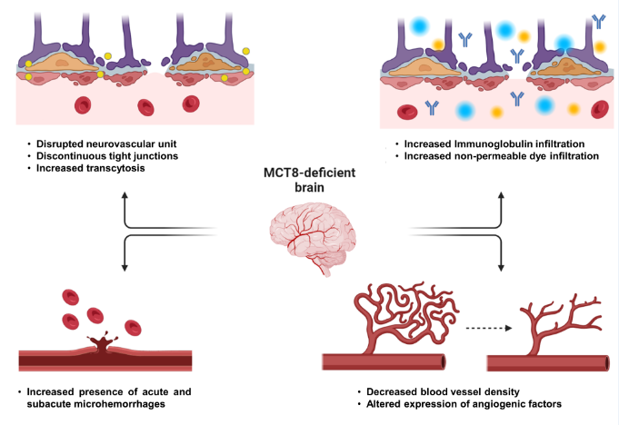 ThyroidLabIIBM's tweet photo. Glad to present you our latest article:
"Neurovascular unit disruption and blood–brain barrier leakage in MCT8 deficiency"
#ADHS #MCT8deficiency #BBB
https://t.co/i3DQWnHSUk
@IIBmCSICUAM @CSICdivulga @BioMedCentral https://t.co/X4JBOx0yZA