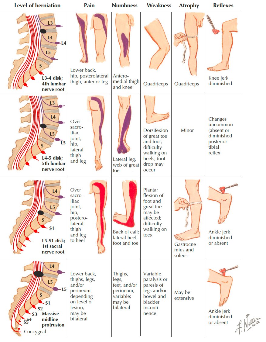 Clinical Features of Herniated Lumbar Nucleus Pulposus according to Netter

👇👇👇

books.google.de/books/about/Ne…