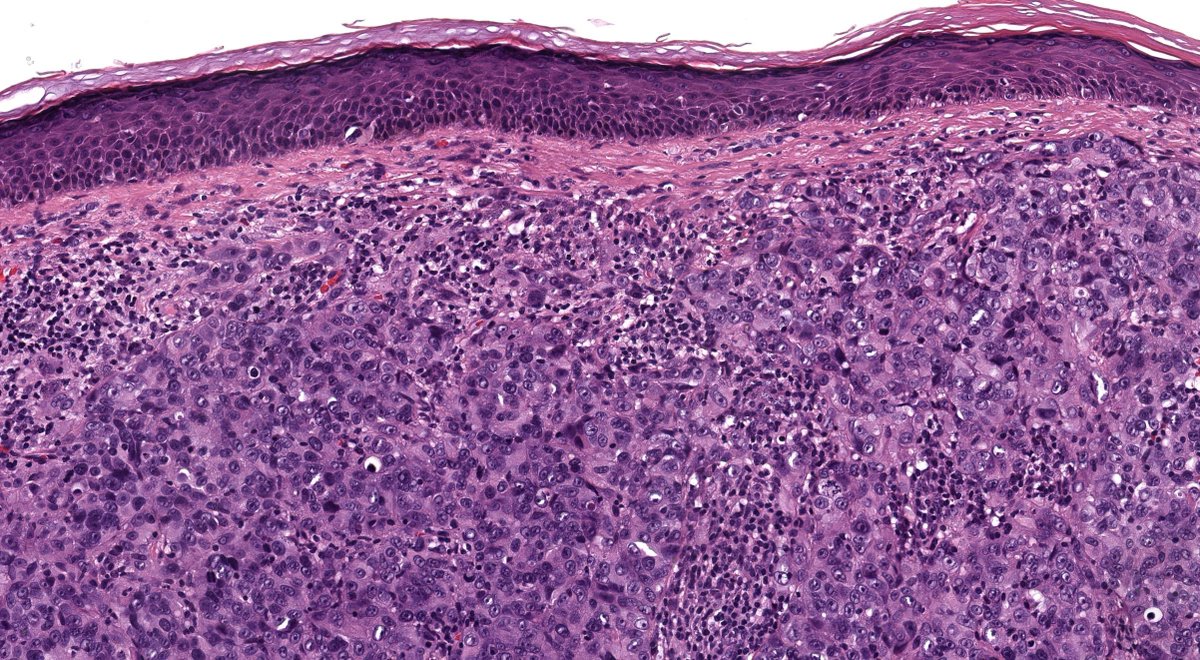 JMGardnerMD's tweet photo. TERRIFYING case! 80 M pink papule nose.
Digital slides &amp; IHC: https://t.co/DshXcw3GEn 
Clinical photo (I would've NEVER guessed dx from this!): https://t.co/82B7eKzlXt
Answer: https://t.co/FVo8mzxehw #pathology #pathologists #pathTwitter #dermpath #dermatology #dermtwitter https://t.co/MaKpqNyhyO