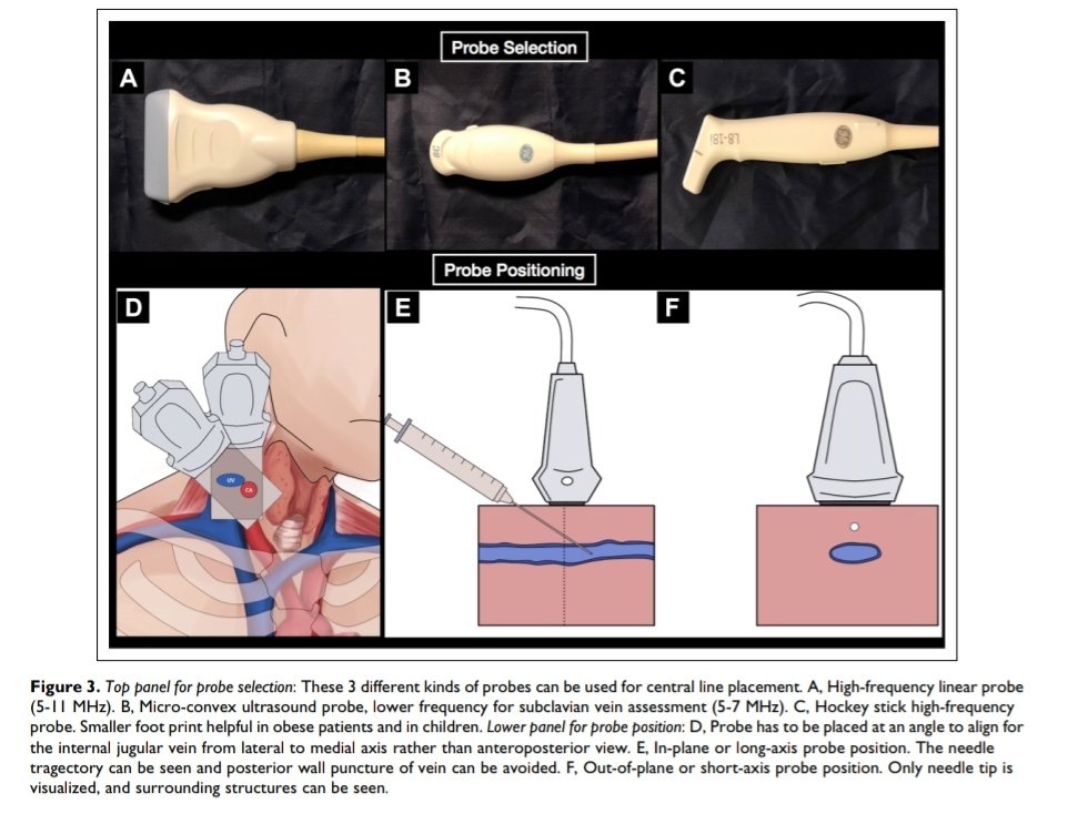 SOMELaguna's tweet photo. Guia Ecográfica para el Acceso Venoso Central - Evidencias y Recomendaciones ‼️👌🏼💉🫀

🔰📚Journal of Intensive Care Medicine

DOI: 10.1177/0885066619868164

Enlace a Articulo Completo 🆓️✅👇🏼
https://t.co/RI53cNdEFq https://t.co/ZQ5yBNegRv
