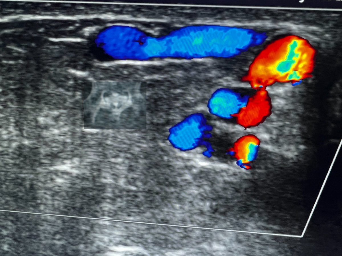 XrayShowNTell's tweet photo. 30F #dialysis w lt #breastlumps. #US w #doppler - tubular 5mm structures + flow c/w #varices. In the setting of hemodialysis, these are at risk for breast #Mondor , vasc. collaterals a/W stenosis, #SVCSynd or obstruction.@G2MPG @SurgeryArticles @surgicalreview @zubowicz @dic_kc https://t.co/UVxc7uuNnu