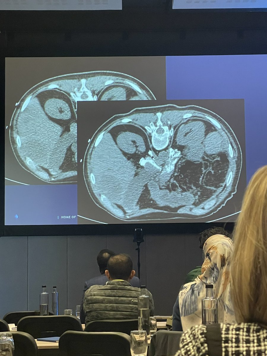 Anthony Hage, MD (@hageirad) on Twitter photo Engaging talk on Neurolysis delivered by <a href="/kantonIR/">Kevin Anton MD, PhD</a> at the SAintS-SAFIRE conference in Cape Town <a href="/JeffCVIR/">Jefferson Interventional Radiology</a> don’t be afraid to switch to that anterior approach to the celiac plexus 🫣 Engaging talk on Neurolysis delivered by <a href="/kantonIR/">Kevin Anton MD, PhD</a> at the SAintS-SAFIRE conference in Cape Town <a href="/JeffCVIR/">Jefferson Interventional Radiology</a> don’t be afraid to switch to that anterior approach to the celiac plexus 🫣