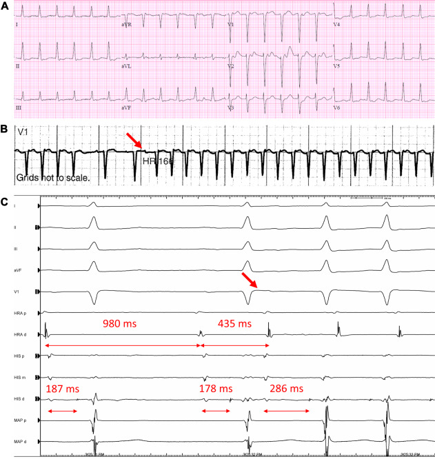 Cardiac magnetic resonance imaging may diagnose underlying idiopathic nonischemic #cardiomyopathy in patients with associated reduced left ventricular ejection fraction.

Learn more in a new study by <a href="/norman_c_wang/">Norman C. Wang, MD, MS</a> ➡️ spr.ly/6014uewJY

#CardioTwitter