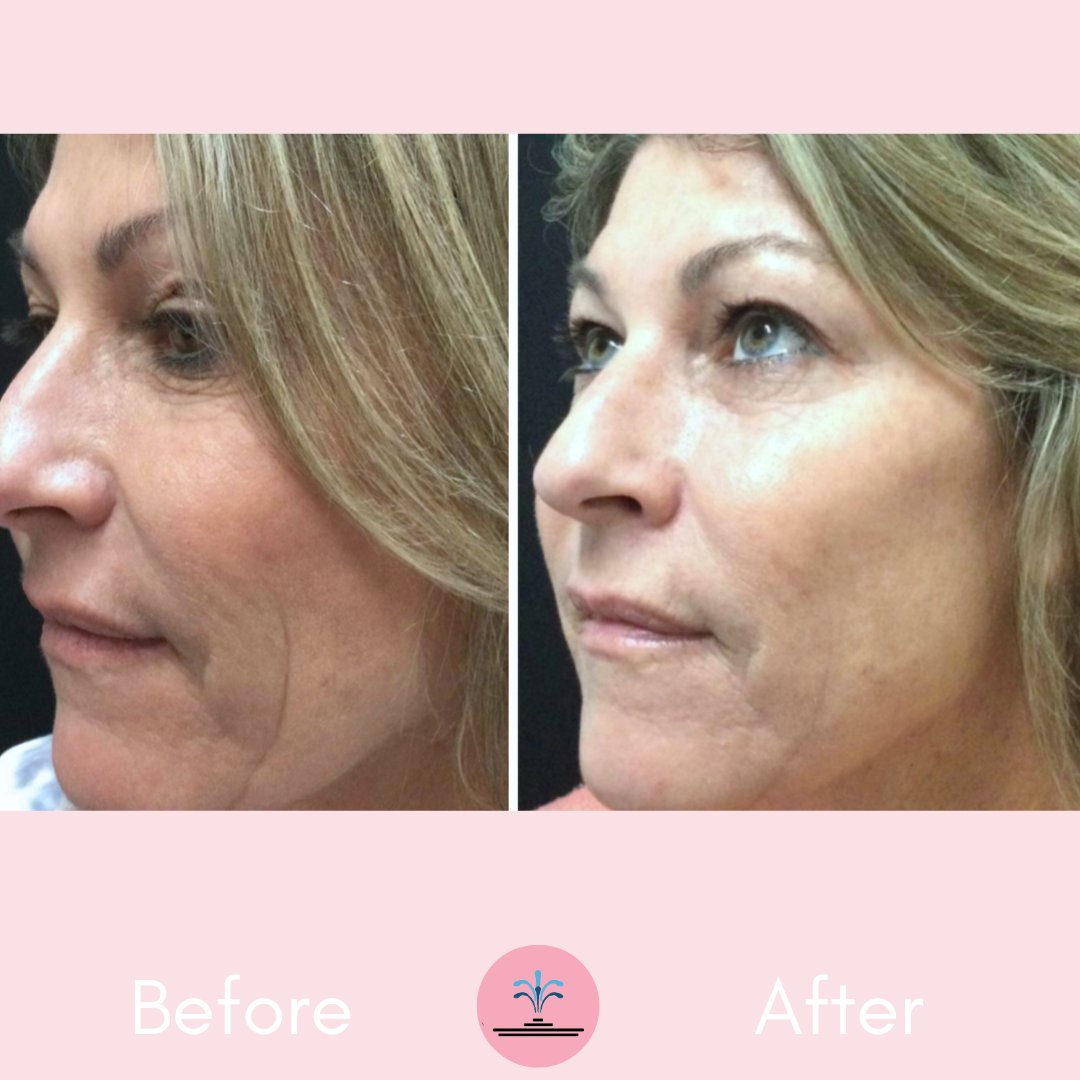 💥FILLER FRIDAY💥 WOW! ADIOS CHEEK LINES.👊 Our Injector, Kristin, used 1 Vollure to treat this patient's bilateral smile lines.🙌 #Fillerfriday #Smilelines #Cheeklines #CosmeticProcedures #BotoxBabes