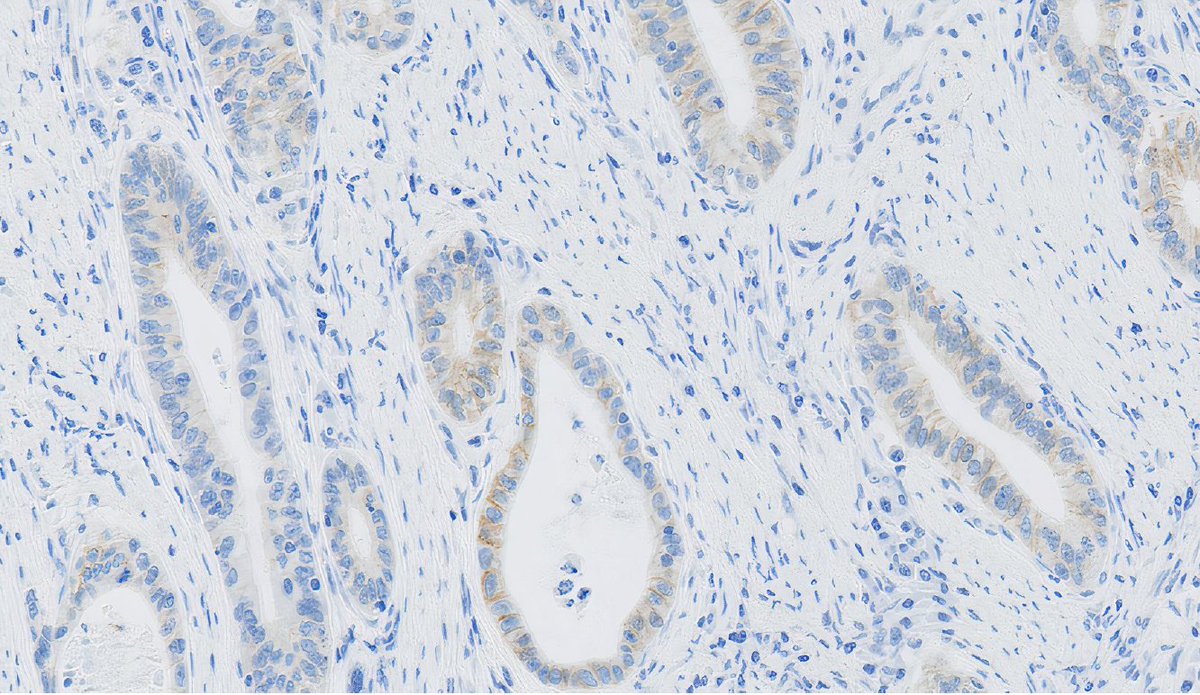 CerbaResearch_'s tweet photo. In this week’s #ImageOfTheWeek, we’re diving deeper into a human epidermal growth factor receptor 2 expression in gastric cancer.

The HercepTest mAB pharmDx is indicated as an aid in the assessment of gastric cancer patients to determine the most appropriate therapy.

#IHC https://t.co/Ywon2EcH0J