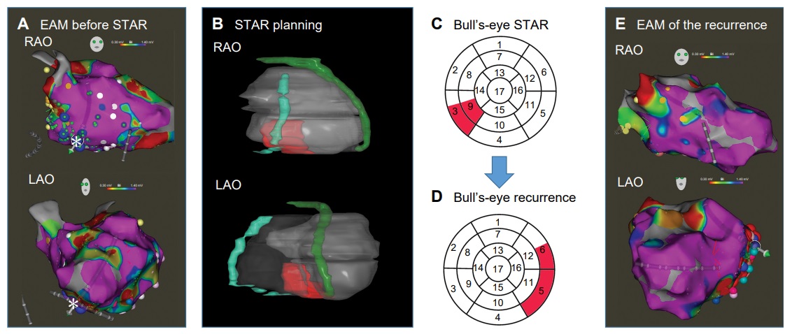 📢#Epeeps #Europace #CardioTwitter 🫀VT Recurrences after sterotact.☢️radioablation arise outside the treated volume: analysis of the 🇨🇭Swiss cohort 🆓📚👉doi.org/10.1093/europa… @GiulioConte9 @Dominik_Linz @marcovitoloMD @AndyZhangMD @FraSantoroMD @LuigiDiBiaseMD @MBergonti