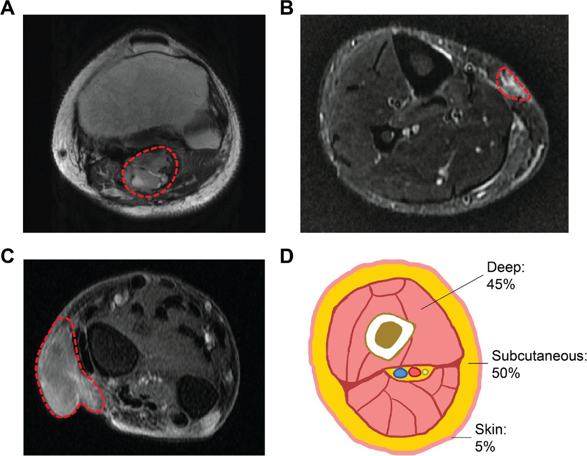 ICYMI in #PracticalRO: Patterns of Local Recurrence and Risk of Skin Recurrence in Soft Tissue Sarcomas After Surgical Resection. #radonc bit.ly/ewongwo1