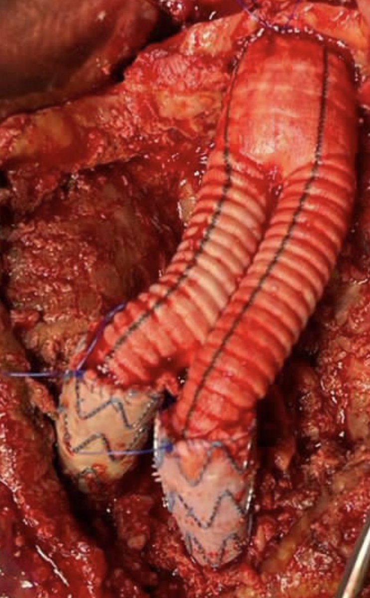 “Get together”…sometimes “Open Repair” need to be done after/with EVAR. Surgical option. Type I refractory endoleak. FEVAR not possible due to tortuosity, calcification and diameter of the external iliac.#vascularsurgery #hospitaldasclinicasribeiraopreto #aorta #aneurysm #usp