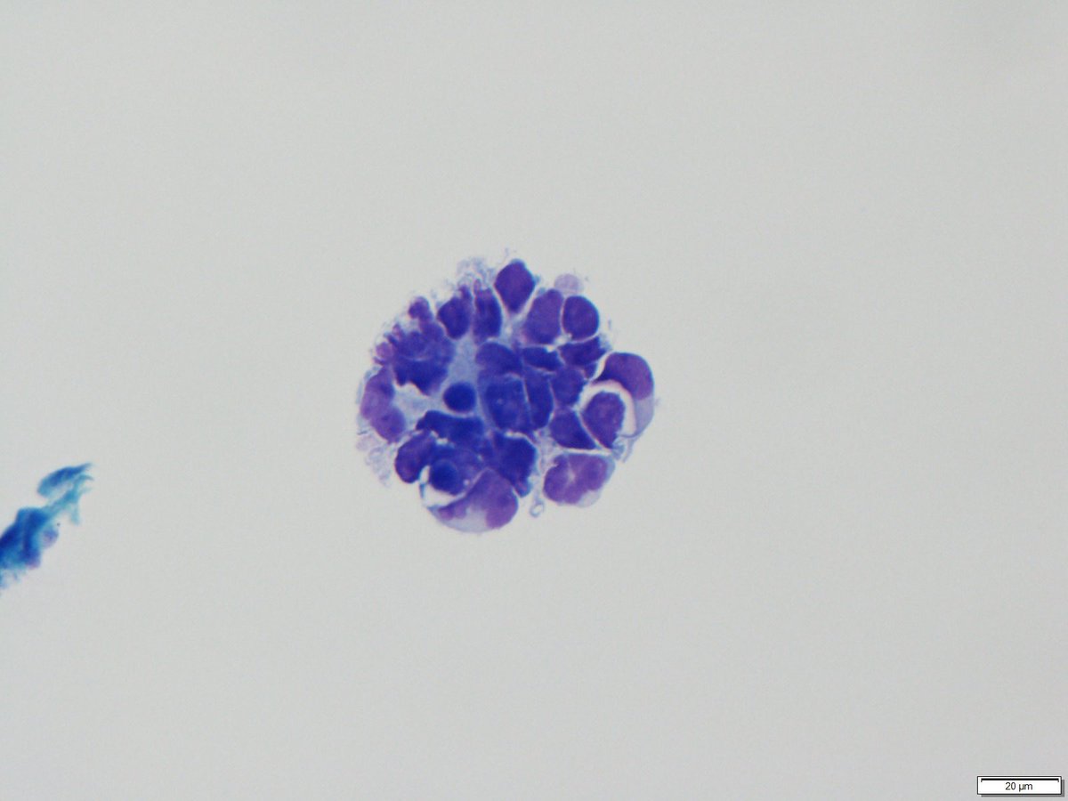 Cluster of cells in the CSF. Is this hematopoietic? Why or why not? #MedTwitter #PathTwitter #cytology #heme