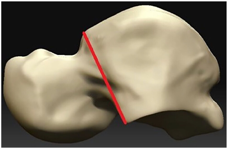AOFAS_Journals's tweet image. A retrospective review of 137 talus fractures showed that talar neck fractures with proximal extension into the talar body (TNPE) were associated with higher rates of avascular necrosis compared to isolated talar neck fractures with an odds ratio of 3.47 doi.org/10.1177/107110…