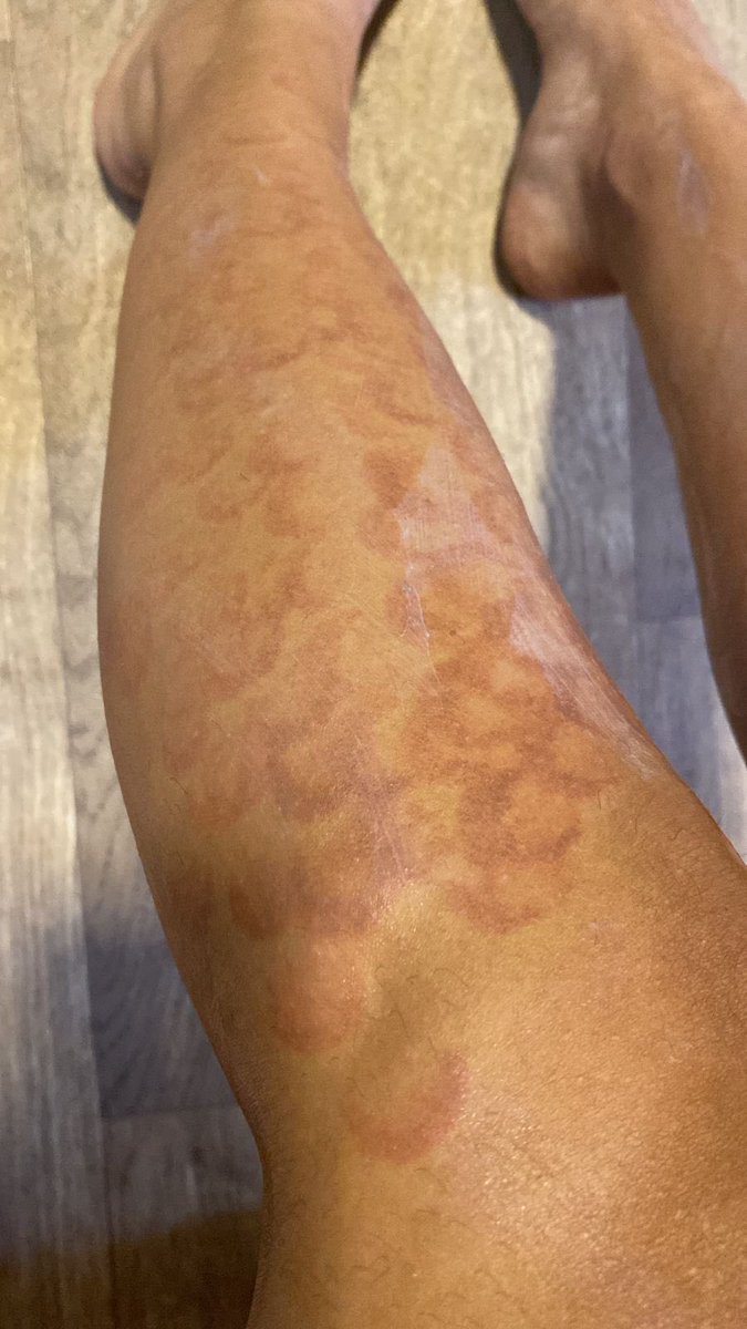 XimenaAcosta96's tweet image. Asi fue como x accidente, me quemaron las piernas con láser alexandrita [ABRO HILO…] 👇🏼
Me realicé sesiones de depilación láser por 7 meses, con una empresa con la cual trabajaba como creadora de contenido. Cabe destacar, que durante ese tiempo JAMÁS pasó nada grave hasta qué..