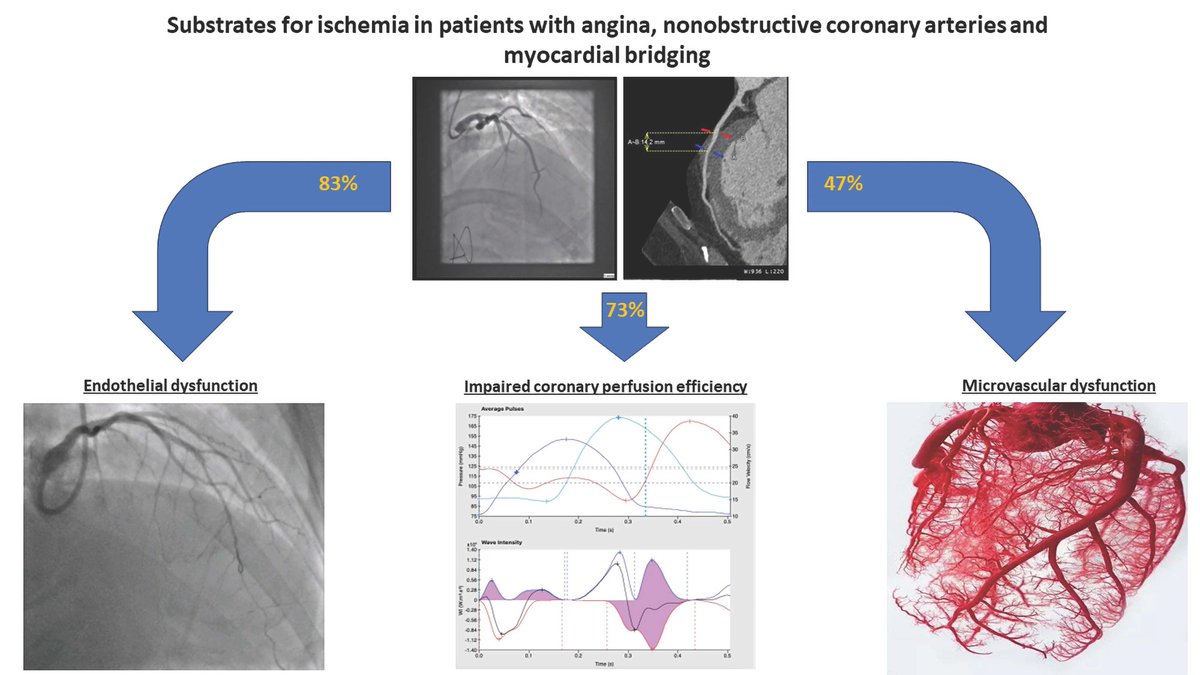 Do Myocardial Bridges Cause Ischemia? Characterising Mechanisms of Ischemia in Patients with Myocardial Bridges. A simultaneous publication to @AHAMeetings #AHA2023. ahajournals.org/doi/abs/10.116… @divaka_perera @AishSinha1 @DrHaseebRahman1 @Ukheartresearch @AHAScience @circAHA