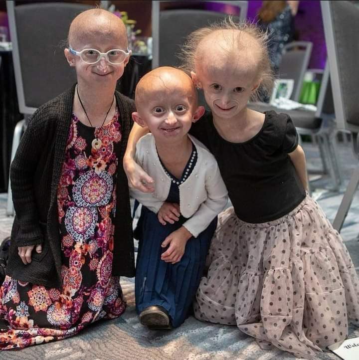InformaCosmos's tweet image. PROGERIA: Es una rara enfermedad genética que produce un envejecimiento rápido en los niños.

Las personas con esta afección casi siempre solo viven hasta los años de la adolescencia (un período de vida promedio de 14 años).