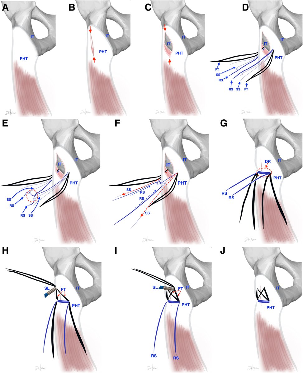 ArthroscopyJ's tweet image. Endoscopic Proximal Hamstring Tendon Repair With Knotless Suture-Bridge Technique #hip #hamstring ow.ly/3ZSr50Q1UXX