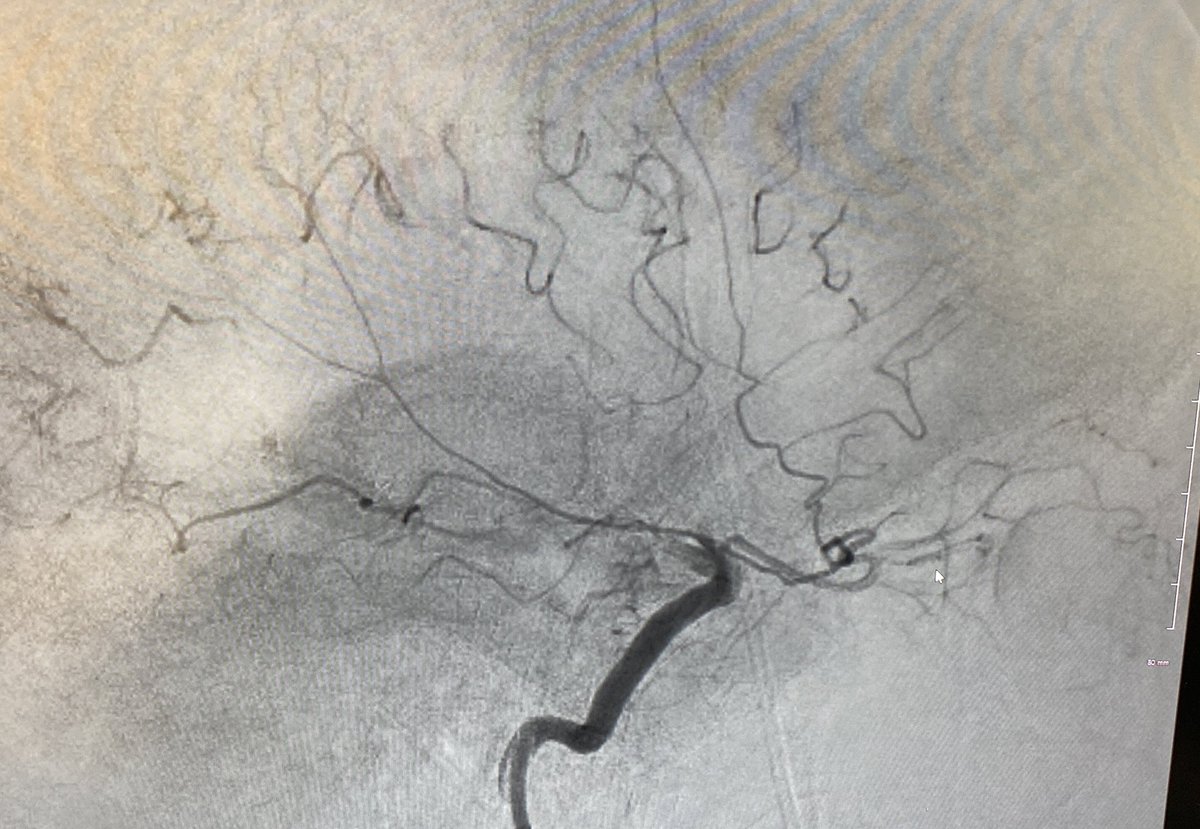 A rare look at a recurrent meningeal artery in a patient with MCA occlusion (and excellent pial collaterals). <a href="/EricRSmithMD/">Eric R Smith</a>