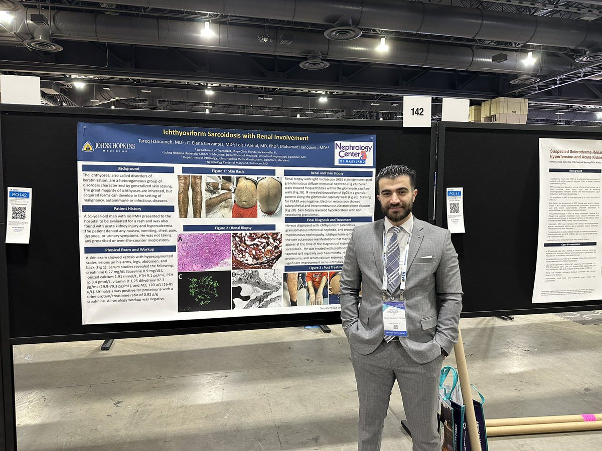 MoHanouneh's tweet photo. @TareqHanouneh presented a case of Ichthyosiform Sarcoidosis with Renal Involvement @ASNKidney. #KidneyWk https://t.co/wOrhPN2aBG