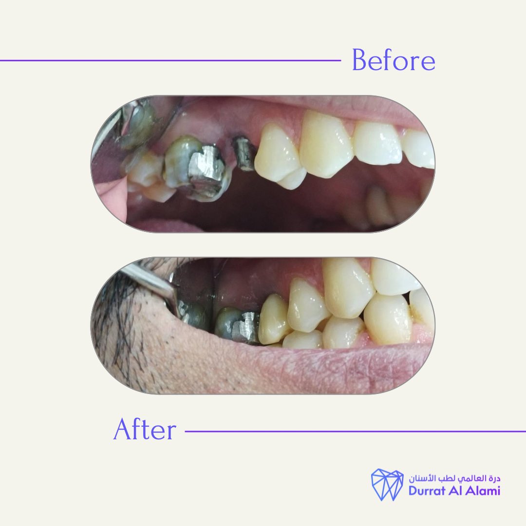 ✨💜

#زراعة_الأسنان #محافظة_شقراء
#درة_العالمي_لطب_الأسنان