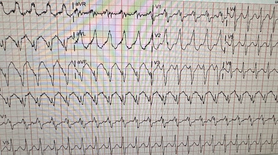 EoinDonnellan1's tweet photo. Impella-supported mid-inferior epicardial LV VT beautifully mapped using OPTRELL with CartoMerge for coronary overlay. Thanks to @BiosenseWebster Tyler Wesley and Rachel Helm. @nmarrouche @Tfury1322 @HadiiYounes https://t.co/GTPoqBnU6G