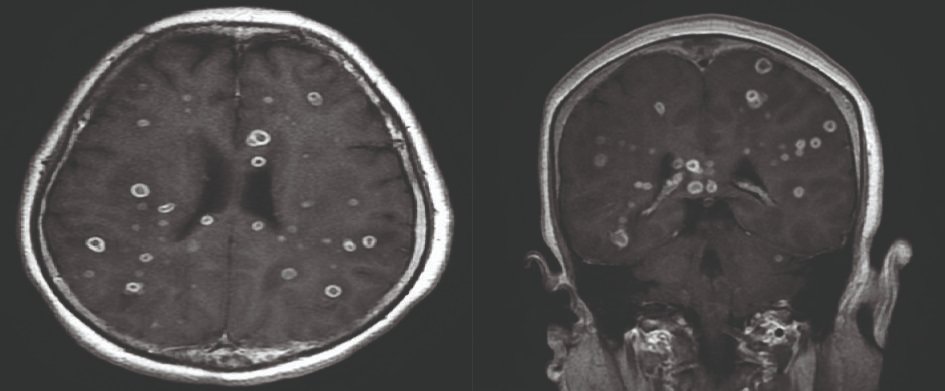 A lady with good past health presenting with acute onset of fever, headache and visual loss

Diagnosis?