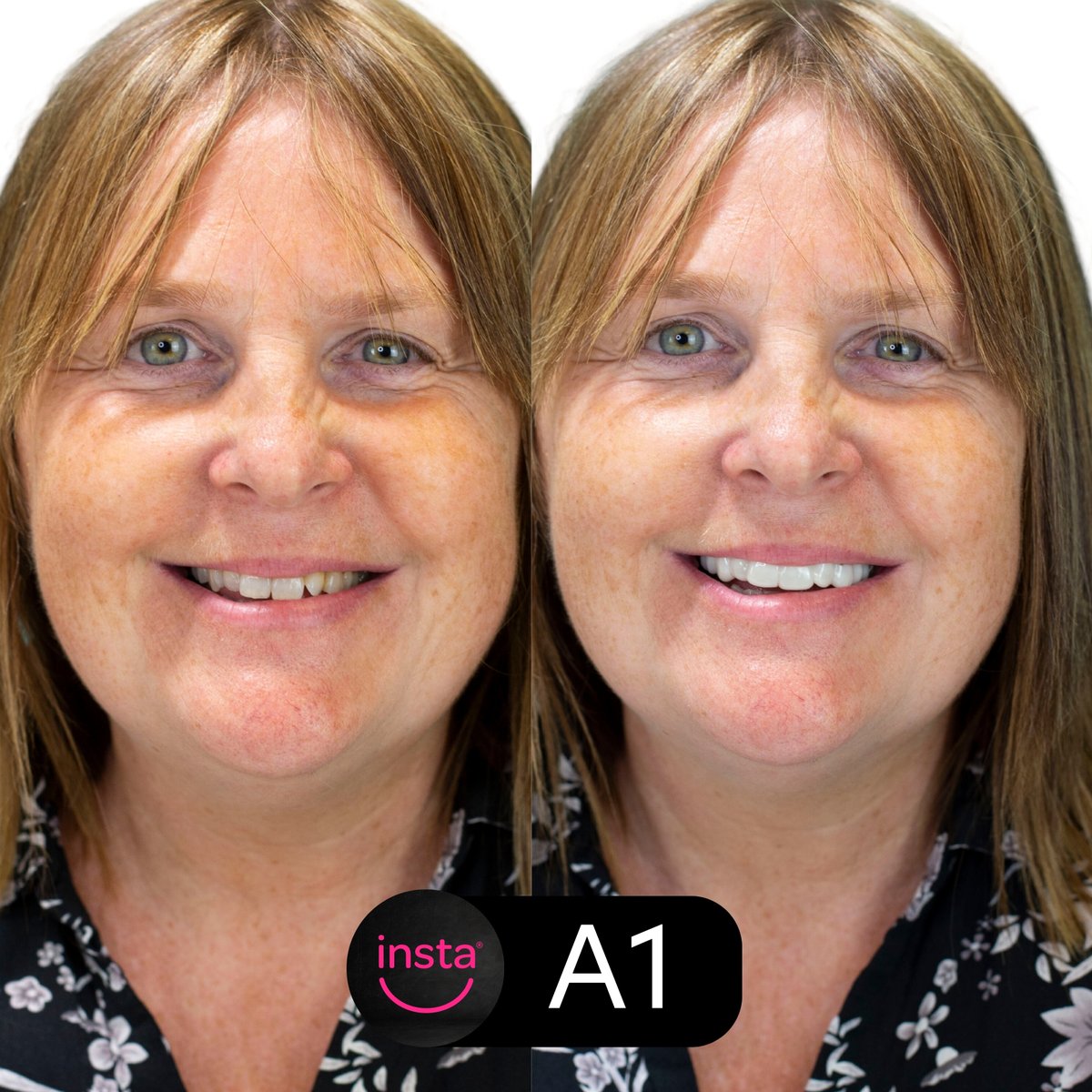 instasmile's tweet image. With instasmile clip-on veneers, you can achieve a radiant and youthful smile like Fiona's in no time. 

#cliponveneers #instasmile #newsmile #radiantsmile