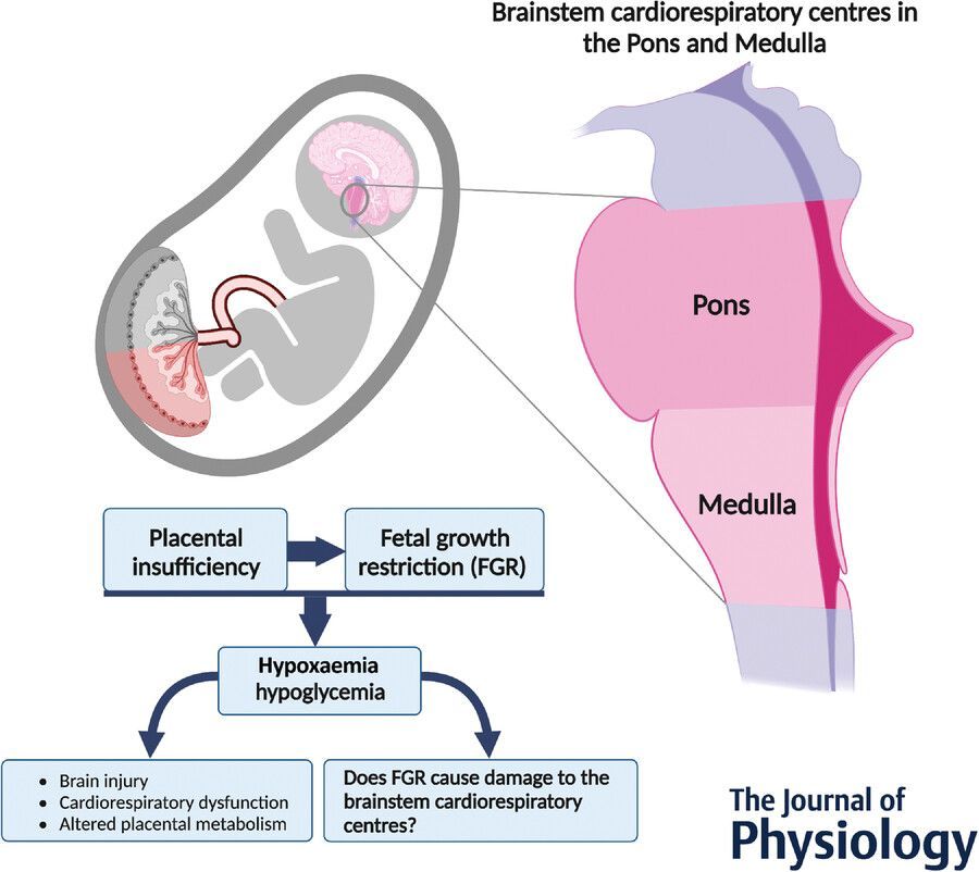 Journal of Physiology (@jphysiol) on Twitter photo <a href="/elazadeh/">Ela Zadeh (Elham Ahmadzadeh), PhD</a>, <a href="/grpolglase/">Graeme Polglase</a>, <a href="/NeuroscienceNes/">Vanesa Stojanovska, PhD</a>, Walker, Miller, <a href="/BethJForbes/">Beth Allison (she/her)</a> (<a href="/RitchieCentre/">The Ritchie Centre</a>) and <a href="/NewPlasticity/">Eric Herlenius</a> (<a href="/karolinskainst/">Karolinska Institutet</a>) assess whether fetal growth restriction induces neuropathology within the developing brainstem, in this #TopicalReview!
buff.ly/40lb66A <a href="/elazadeh/">Ela Zadeh (Elham Ahmadzadeh), PhD</a>, <a href="/grpolglase/">Graeme Polglase</a>, <a href="/NeuroscienceNes/">Vanesa Stojanovska, PhD</a>, Walker, Miller, <a href="/BethJForbes/">Beth Allison (she/her)</a> (<a href="/RitchieCentre/">The Ritchie Centre</a>) and <a href="/NewPlasticity/">Eric Herlenius</a> (<a href="/karolinskainst/">Karolinska Institutet</a>) assess whether fetal growth restriction induces neuropathology within the developing brainstem, in this #TopicalReview!
buff.ly/40lb66A