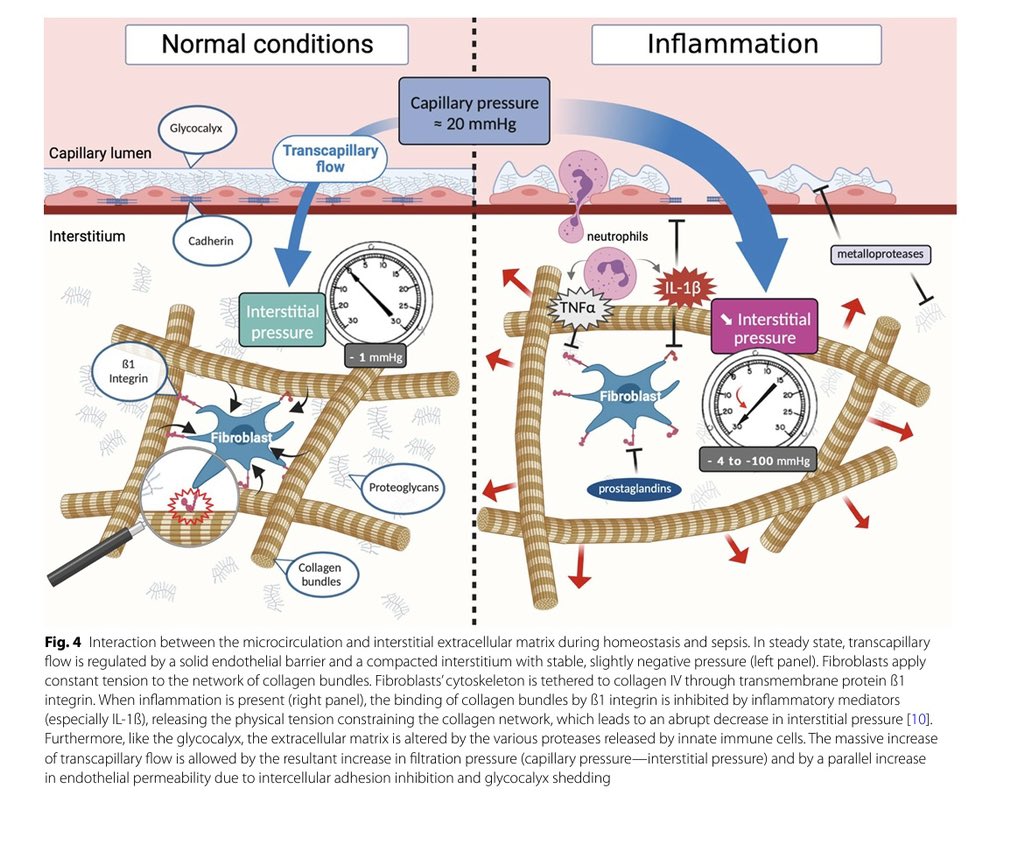 ARUMED1's tweet photo. 🗣️El intersticio en choque #séptico 

1️⃣Aumento de edema 
2️⃣Disregulación de la presión intersticial ⬆️ el flujo transcapilar
3️⃣Alteración de la matriz extracelular
4️⃣Secreción de mediadores inflamatorios
5️⃣ ⬇️ del flujo linfático.

https://t.co/zPzTe2OkVV https://t.co/2Ylzc2JGKY