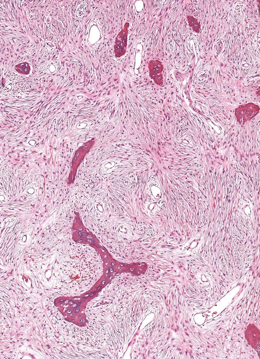 JMGardnerMD's tweet photo. Child with expansile intramedullary bone lesion.
What syndromes can this occur in? What gene mutation?
Answers & WSI digital slide: https://t.co/mRuBOeVmQ2
Video: https://t.co/QaUbUQeJQf
#BSTpath #pathologists #pathTwitter #orthotwitter #radpathmatch #radiology #radstwitter https://t.co/3wvPXW4eyL