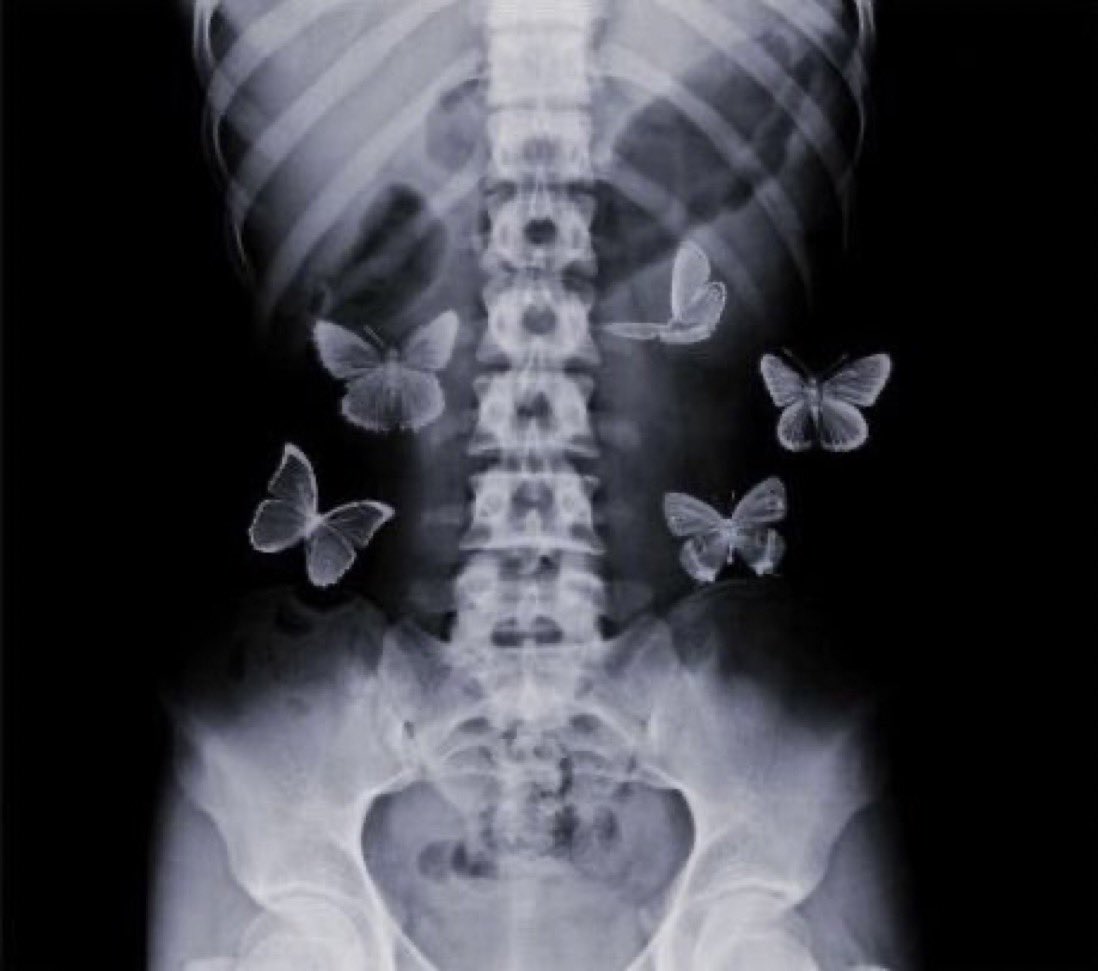 " فراشات المعدة " 🦋 
هو تعبير لما يحدث عندما تكون "متوتراً أو قلقاً" بشأن موضوع ما فتشعر عندئذٍ بحركات غريبة تشابه حركة الفرشات داخل معدتك ..!
شعور الفراشات هذا يحدث نتيجة زيادة إفراز هرمون الادرينالين بالجسم مما يزيد دقات القلب و يقلل وصول الدم للمعدة و يوجهه للعضلات.