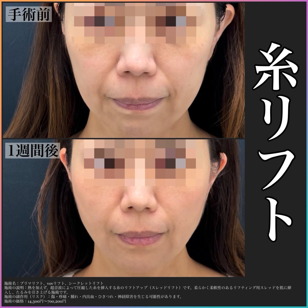 フェイスリフトのSNS口コミ☆3.67(231件)｜おすすめクリニック10選