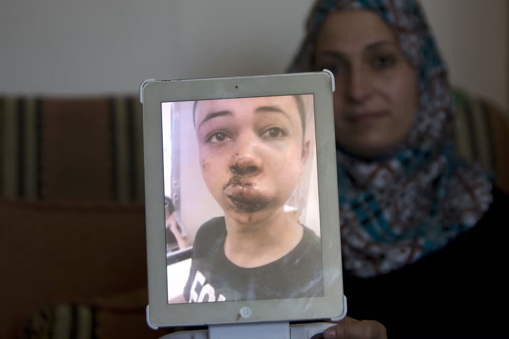 DaniMayakovski's tweet image. Tarek Abu Khadir, un niño palestino de 15 años, que fue brutalmente torturado por la policia sionista que se vió obligado a sacarlo de su celda porque era estadounidense y tuvo que llevarlo a juicio con la cara morada. (2014)

El niño fue apalizado en su detención hasta el punto…