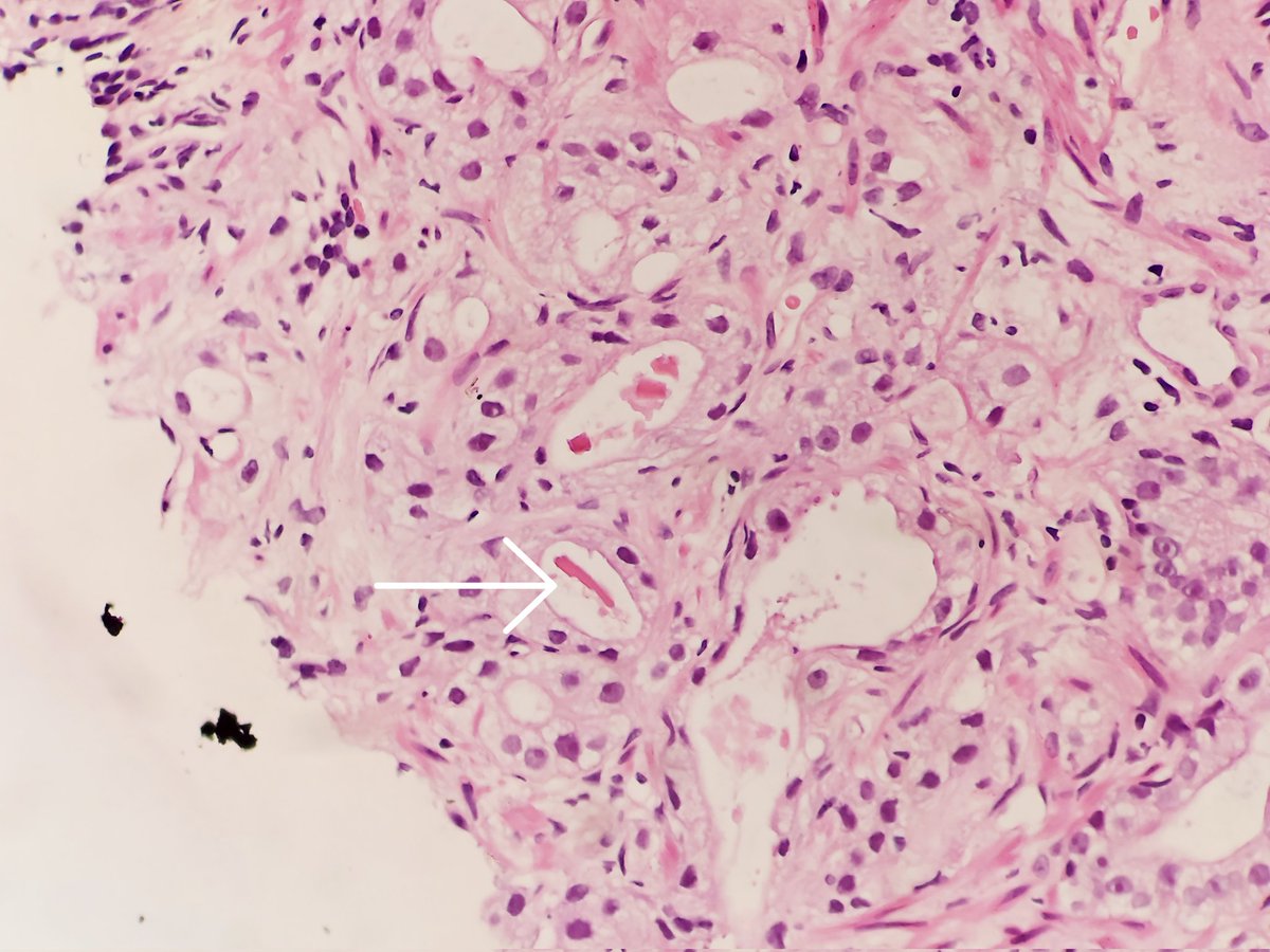 padmapathology1's tweet photo. #pathology #pathtwitter #gupath
Crystalloids in #CaProstate
#pathclassics https://t.co/TBkcyzyCjh