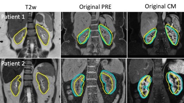 Style Transfer–assisted #DeepLearning Method for Kidney Segmentation on Multiphase MRI Scans doi.org/10.1148/ryai.2… <a href="/UTSW_Radiology/">UTSW Radiology</a> <a href="/UTSWUrology/">UT Southwestern Urology</a> #kidney #ML #MachineLearning