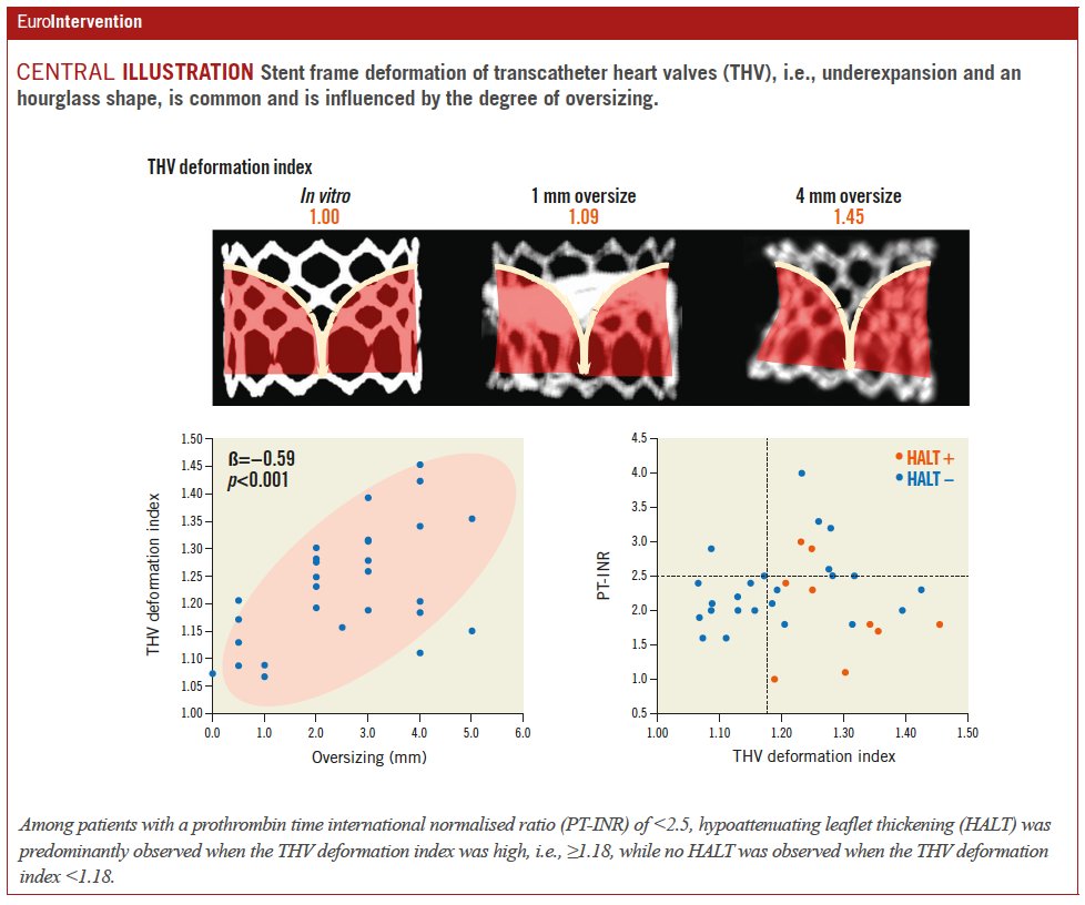 Transcatheter heart valves deformation (THV), i.e., underexpansion and an hourglass shape, commonly occurs after MViV implantation and is negatively affected by excessive oversizing. Optimising THV expansion during MViV could potentially prevent HALT. ow.ly/aebu50Q4eOJ