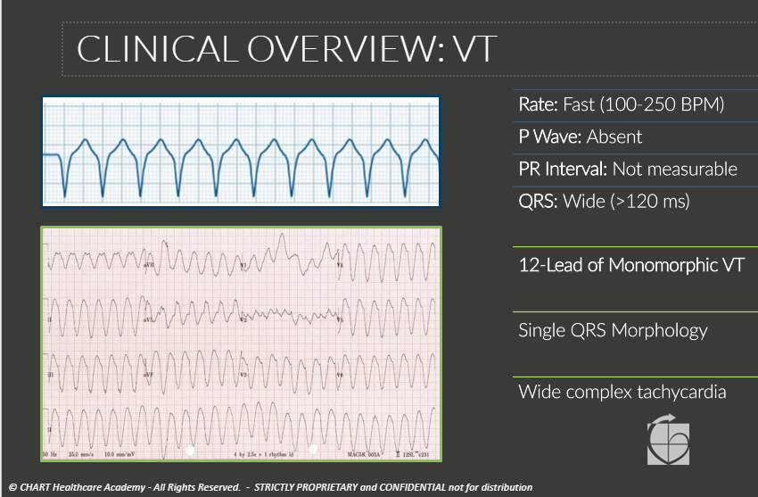 ChartAcademy's tweet photo. 📅 Lock your calendar - 2 EP Pro courses!
1️⃣ Ischemic VT Course on 11/14
2️⃣ PVC Localization Course on 12/12
https://t.co/nPaSYearOP🤓
Blogs on determining PVC origin by @epnerdjen!
🌎https://t.co/RntCrxPByu
📱https://t.co/z4qo5DKTSa
#BuildConfidence #EPNerd #EPeeps #VivaEP https://t.co/OnENtzMcqD