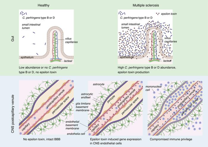 MicrobesInfect's tweet image. Researchers discovered potential link between #Clostridium perfringens &amp;amp; progression of #MultipleSclerosis (MS).

The study suggests that an epsilon toxin from the bacteria might degrade the blood-brain barrier, initiating the debilitating symptoms of MS.

neurosciencenews.com/multiple-scler…
