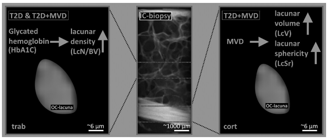 A new study using micro-CT imaging to demonstrate a larger cortical osteocyte lacunar volume in patients with type 2 diabetes mellitus and microvascular disease compared with patients without MVD #openaccess #ASBMR @Snapastian @eth_bone @frost_nielsen ow.ly/IZPF50Q2Ae3