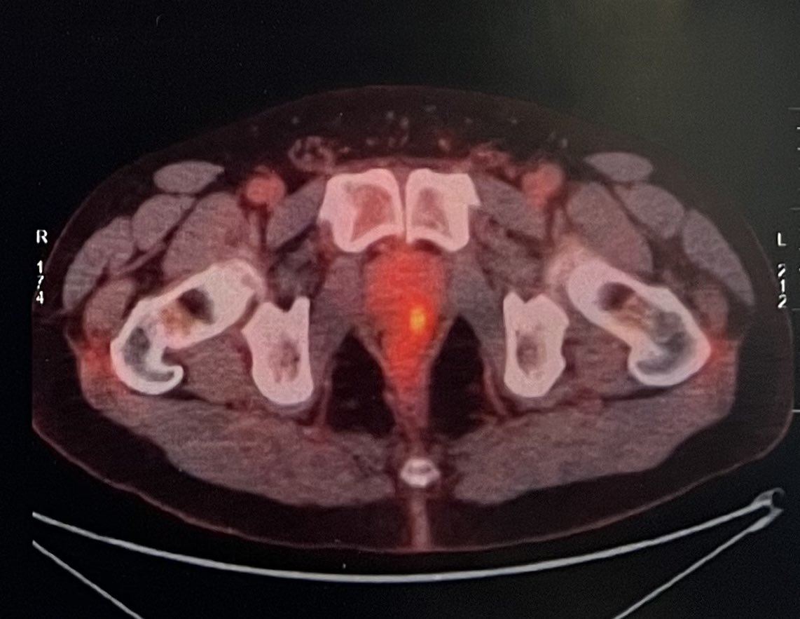 RomanCarvajal's tweet image. 66 yo, thyroid cancer, 18FDG-PET/CT w incidental uptake FDG in the #prostate, normal DRE, PSA 1.1 ng, mpMRI P4 left lobe, histopathology ISUP2, 5 left cores +

A new kid on the block?

#molecularimaging is coming and changing the scene @UroTeragLATAM @dandanmena