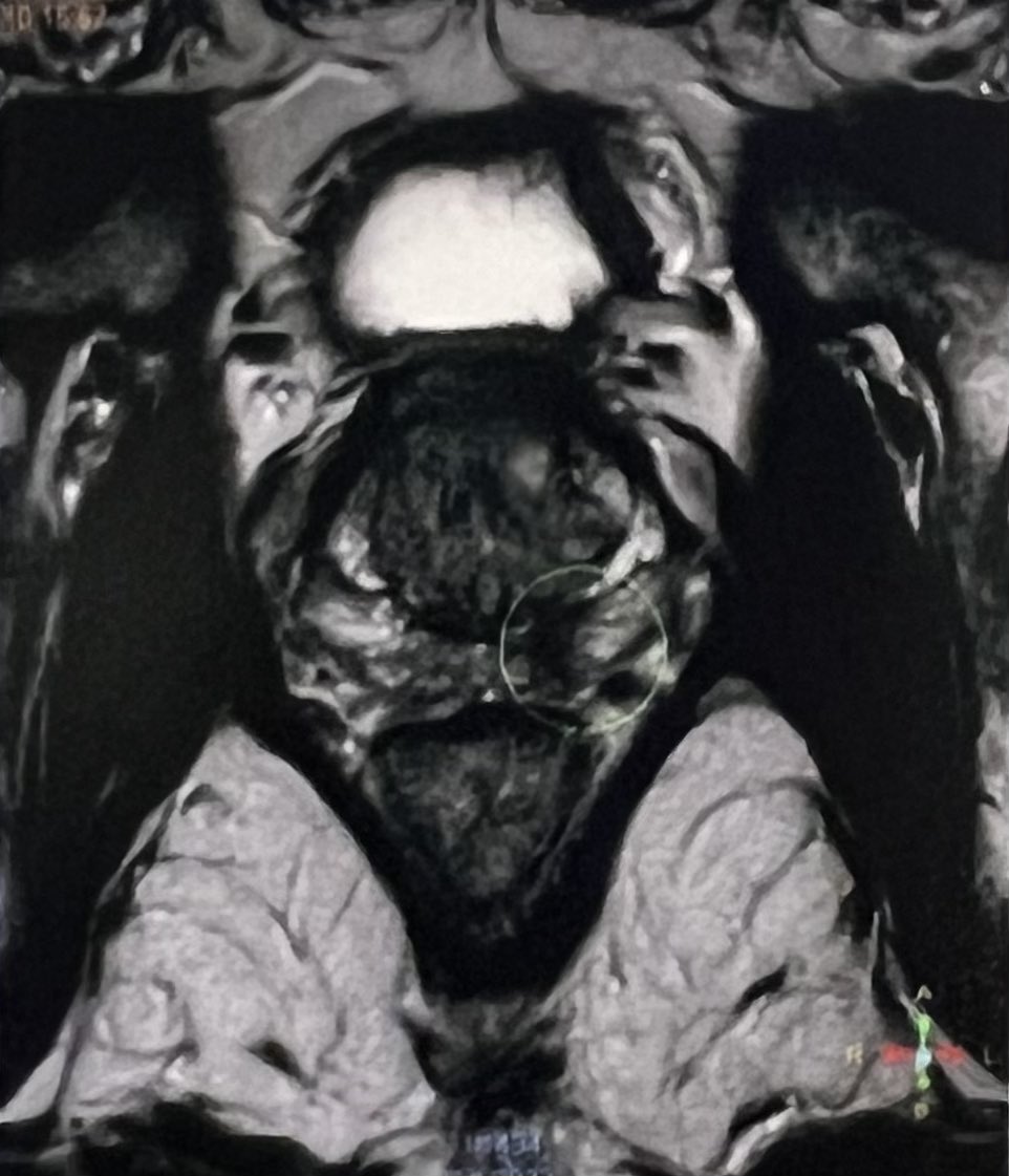 RomanCarvajal's tweet image. 66 yo, thyroid cancer, 18FDG-PET/CT w incidental uptake FDG in the #prostate, normal DRE, PSA 1.1 ng, mpMRI P4 left lobe, histopathology ISUP2, 5 left cores +

A new kid on the block?

#molecularimaging is coming and changing the scene @UroTeragLATAM @dandanmena