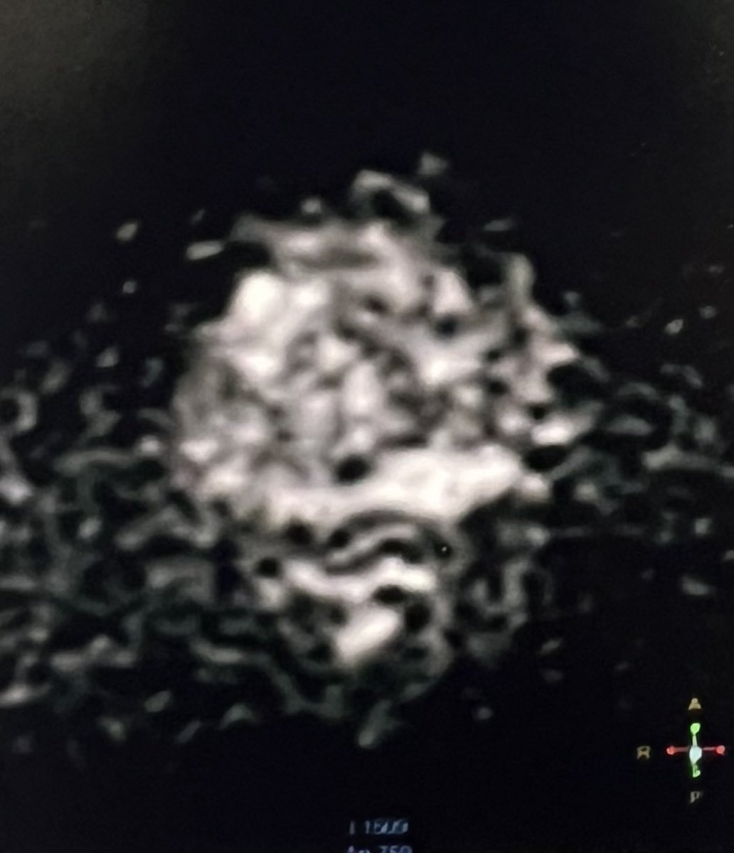 RomanCarvajal's tweet image. 66 yo, thyroid cancer, 18FDG-PET/CT w incidental uptake FDG in the #prostate, normal DRE, PSA 1.1 ng, mpMRI P4 left lobe, histopathology ISUP2, 5 left cores +

A new kid on the block?

#molecularimaging is coming and changing the scene @UroTeragLATAM @dandanmena