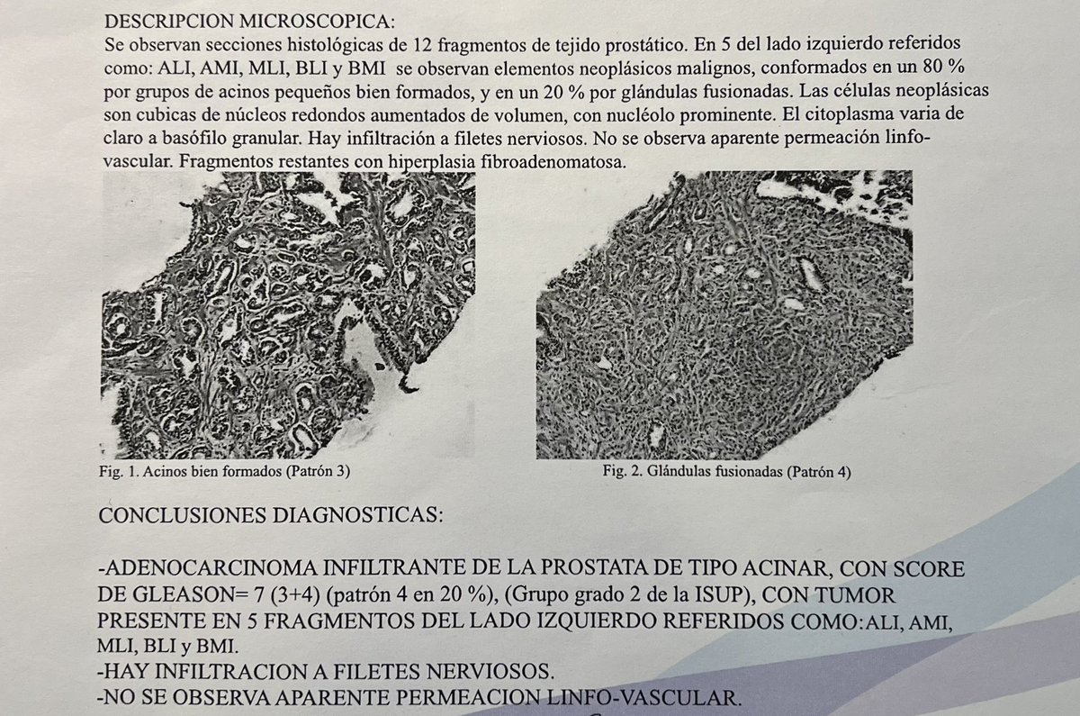 RomanCarvajal's tweet image. 66 yo, thyroid cancer, 18FDG-PET/CT w incidental uptake FDG in the #prostate, normal DRE, PSA 1.1 ng, mpMRI P4 left lobe, histopathology ISUP2, 5 left cores +

A new kid on the block?

#molecularimaging is coming and changing the scene @UroTeragLATAM @dandanmena